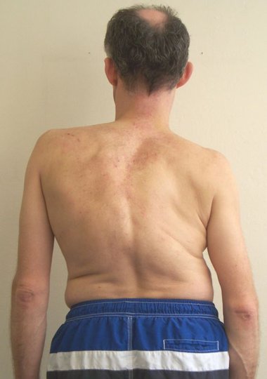Adult correcting scoliosis